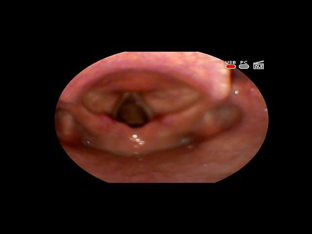 #ФИБРОМА #ГОРТАНИ ПЕВЧЕСКИЙ УЗЕЛОК #ГОЛОСОВОЙ СКЛАДКИ