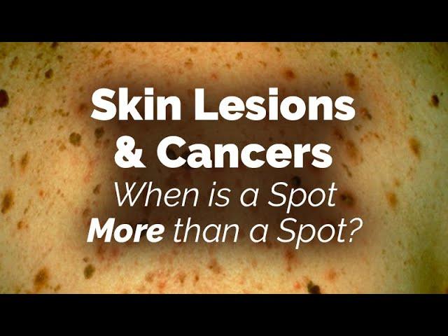 When is a Spot More than a Spot? Skin Lesions and Cancers