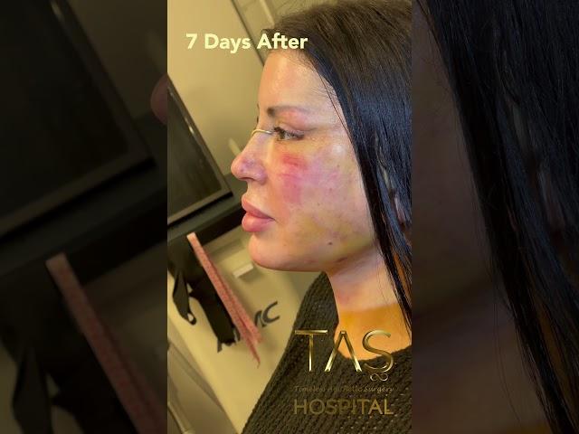 Complete Facial Transformation: Scarless Facelift, Necklift & Rhinoplasty by DR Tas