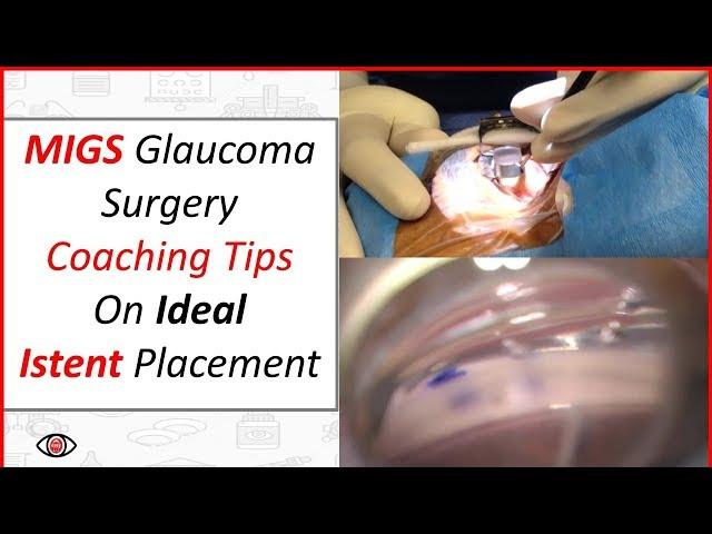 MIGS Glaucoma Surgery - Coaching Tips on Ideal iStent Placement