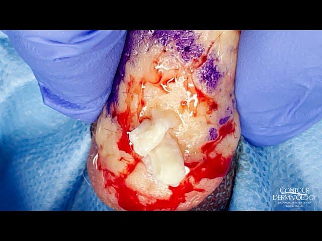 What Happens When You Pop A Sebaceous Cyst (with Sac Removal) | CONTOUR DERMATOLOGY