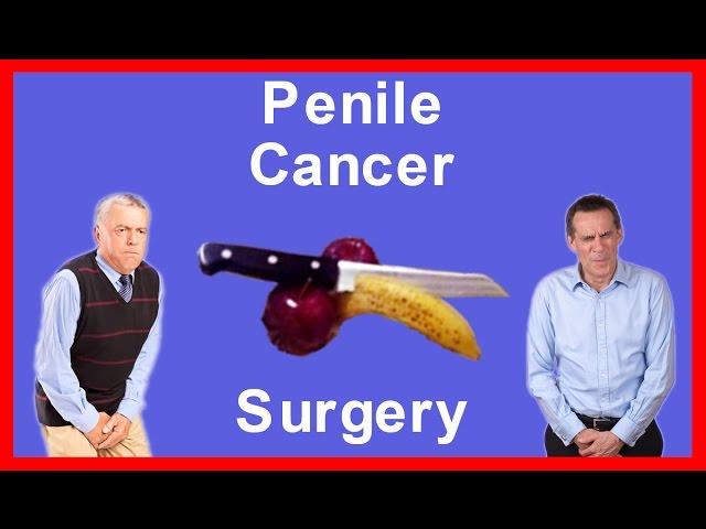 Ca Penile - How to do Penectomy for Penile Cancer and Lymphnode Dissection Surgery by Dr Majid Ahmed