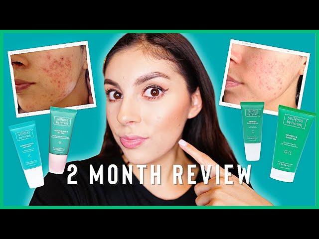 I am surprised... | Selfless by Hyram Review on ACNE PRONE SKIN Full 2 Month Review