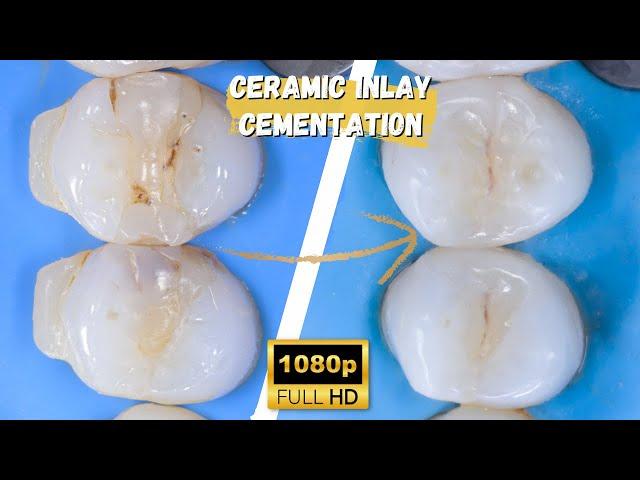 INLAY DELIVERY WITH WARM COMPOSITE | A BIOMIMETIC APPROACH