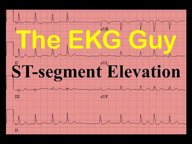 EKG/ECG ST-segment Elevation - Question 9.0 | The EKG Guy