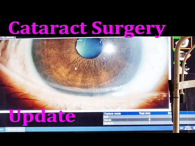 Cataract Surgery Update - Left Eye (4K)
