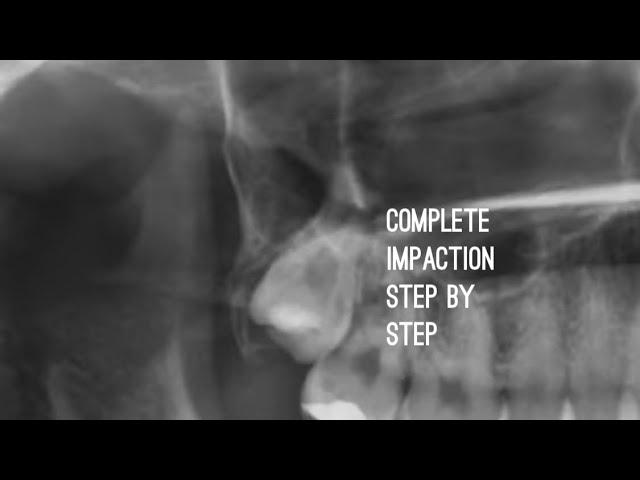 Complete Bony Impaction Third Molar Extraction Video