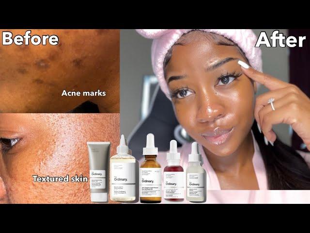 PRODUCTS THAT REMOVE DARK MARKS & TEXTURED SKIN FAST | The ordinary