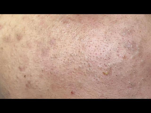 Blackheads Under The Skin | Mụn Đầu Đen Dưới Da - SacDepSpa#301