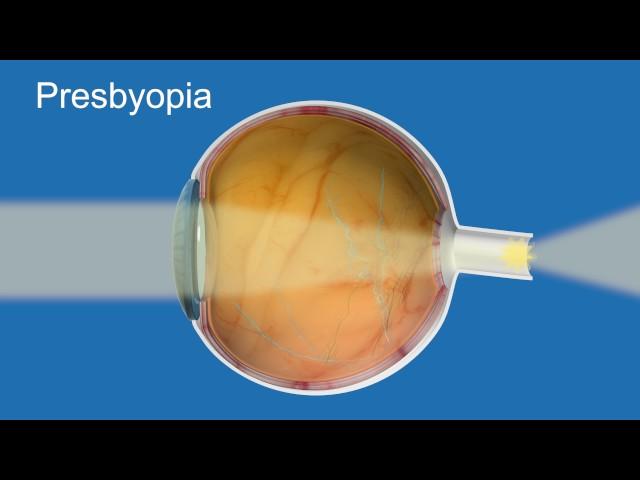 Presbyopia