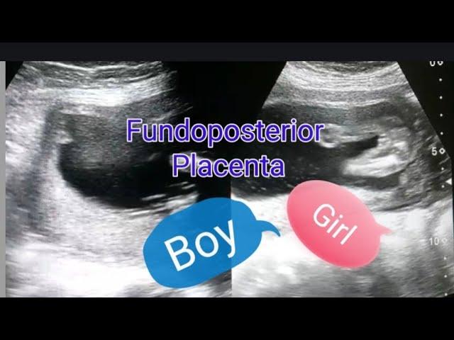 Fundoposterior placenta | Anterior placenta means baby boy? | Posterior placenta means baby girl?