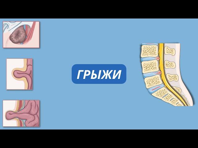 что такое грыжа? виды и лечение