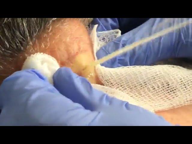 Large Cyst Squirts and Oozes from Patient's Neck