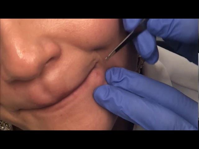 Cyst Removal