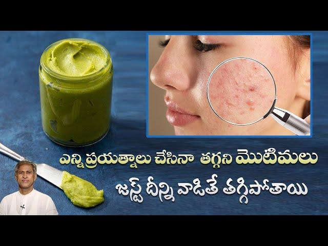 Pimple Face Pack | Reduces Acne Scars | Get Rid of Oily Skin | Smooth Skin | Manthena's Beauty Tips