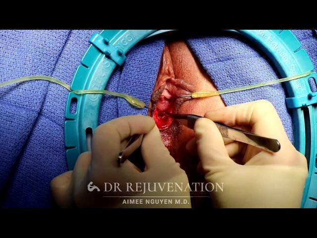 How To Become A VIRGIN Again - Hymenoplasty