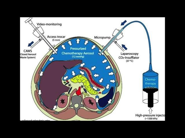 PIPAC, step-by-step | Dr. Vinay Samuel Gaikwad | CK Birla Hospital