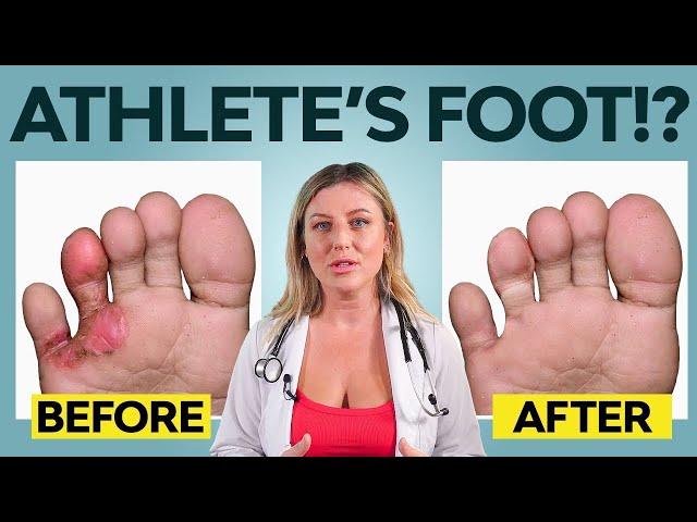 5 Ways to get Rid of Athletes Foot | Treatment