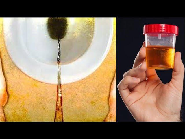 4 Reasons Why Your Urine is Dark in Color