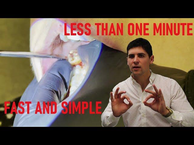 Wisdom tooth removal (extraction) in under one minute, with surprise at the end. No forceps needed