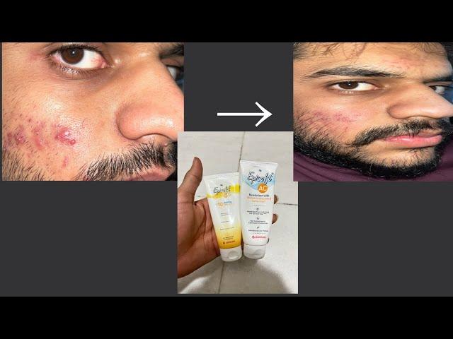 Episoft spf 30 suscreen review|Episoft spf 50|Sunscreen for winter acne prone skin|