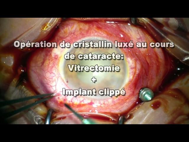 Opération de cristallin luxé au cours de cataracte vitrectomie+implant clippé Dr Pierre-André DUVAL