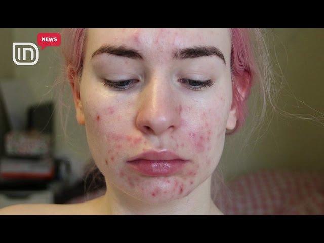 Aknet te adoleshentët. Britani, problemi shtohet se mungojnë dermatologët