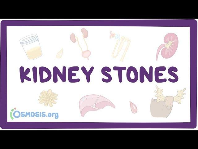 Kidney stones (nephrolithiasis) - an Osmosis Preview