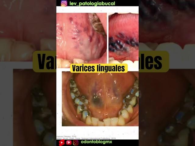 Várices linguales #shorts #varices #várices #variceslinguales #váriceslinguales #odontoblogmx