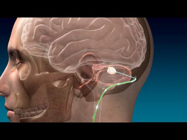 Deep Brain Stimulation for Stroke Recovery Animation