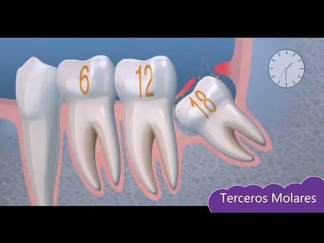 Tema 5: Cirugía Oral: Terceros Molares.