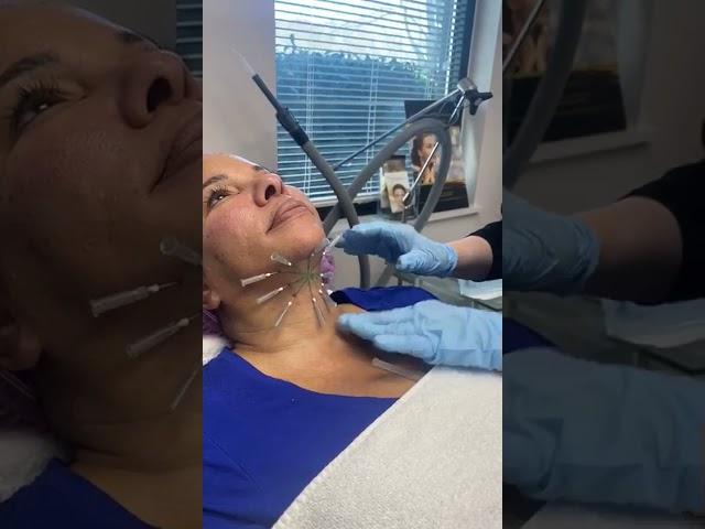 PDO Threads to tighten and lift neck - nonsurgical neck lift by Dr. Pamela Kulback