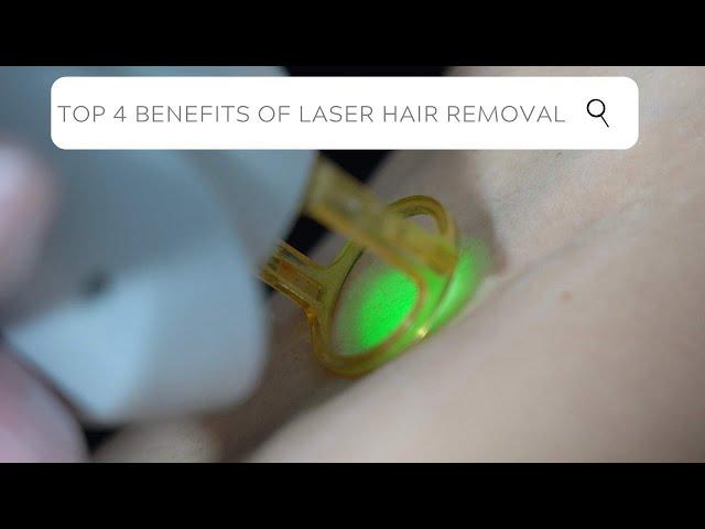 Top 4 Benefits of Laser Hair Removal