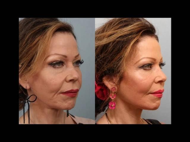 Female Revision Facelift Necklift Before and After  Dr. Edwin Williams