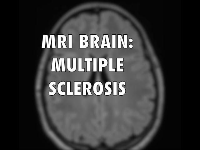 Multiple Sclerosis MRI