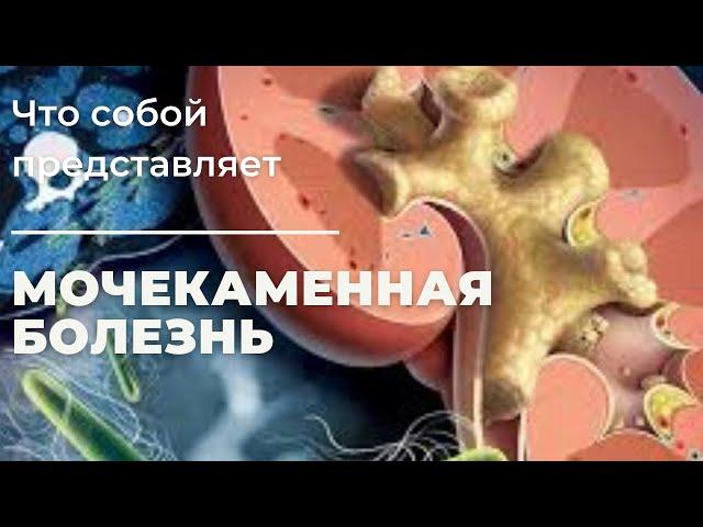 Мочекаменная болезнь лекция для студентов (рус)