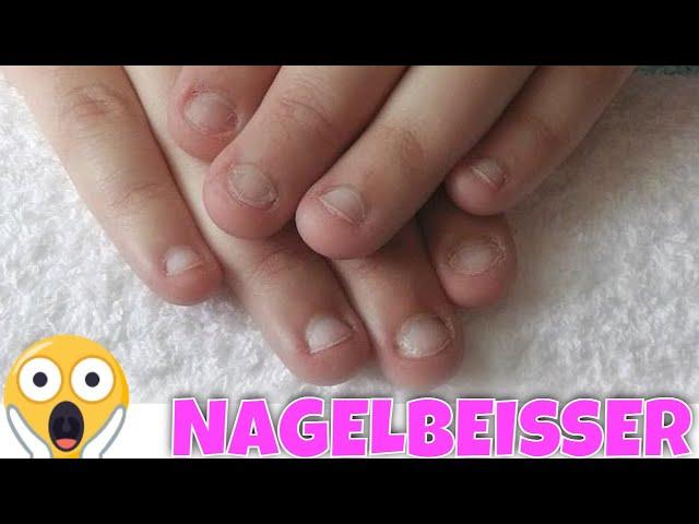 NAGELBEISSER EXTREM!  Tipps undAnleitung für Gelnägel Modellage | Lyninails