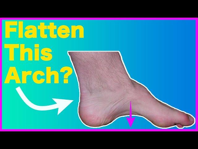 High Foot Arch – This 1 Trick Fixes It