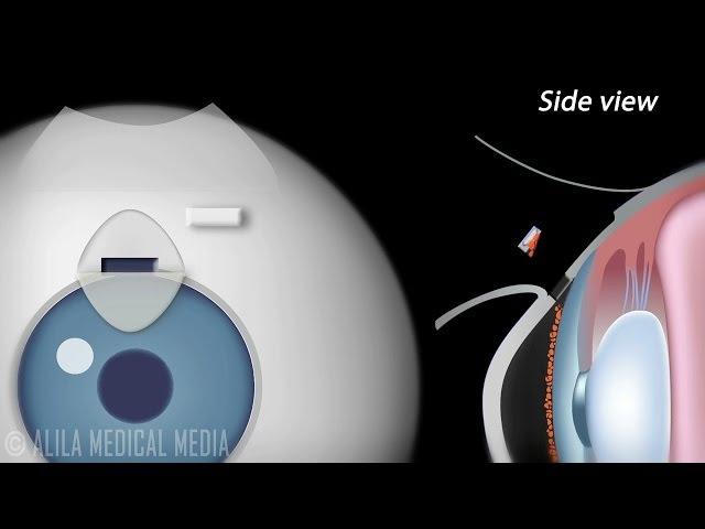 Trabeculectomy Surgery for Glaucoma, Animation.