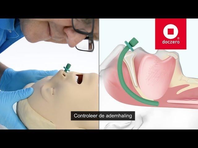 Nasopharyngeal Airway Insertion | Doczero E-learning