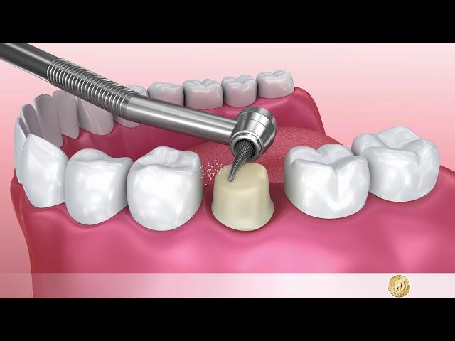 Fixed dental restoration: Crowns