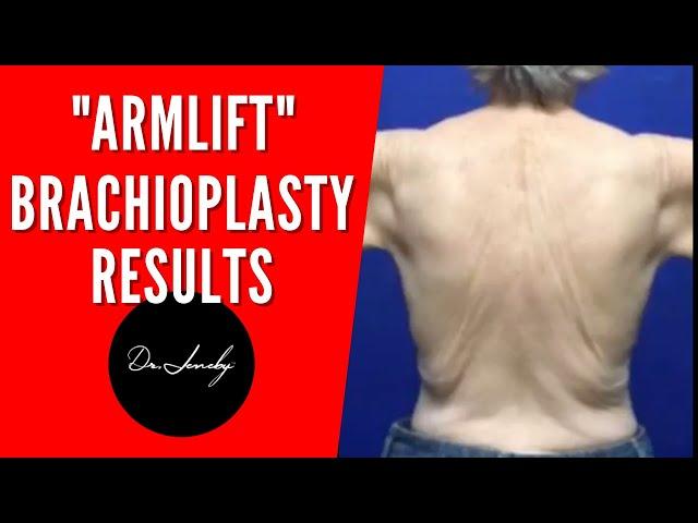 Brachioplasty ( Armlift) Results DrJeneby ! #shorts