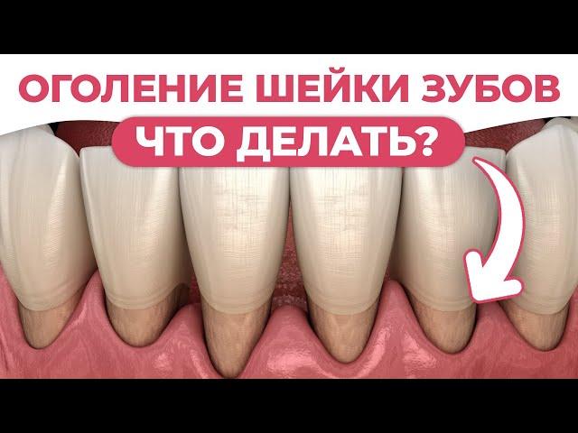 СИНДРОМ «ИСЧЕЗНУВШЕЙ ДЕСНЫ» / Все о рецессии зубов и как от нее избавиться / Оголяются КОРНИ ЗУБОВ