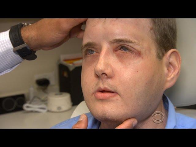 Face transplant recipient thriving one year after surgery