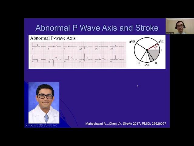 L. Chen  | P Wave Parameters and Indices: A Critical Appraisal of Clinical Utility, Challenges, ...