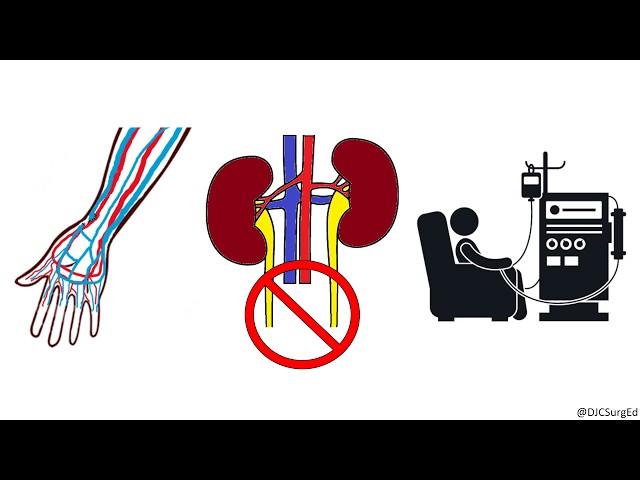 Arteriovenous (AV) Fistulas