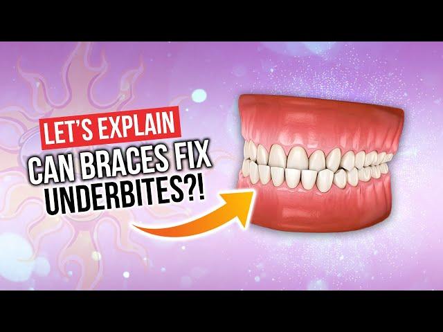 Can Braces Fix UNDERBITES?!