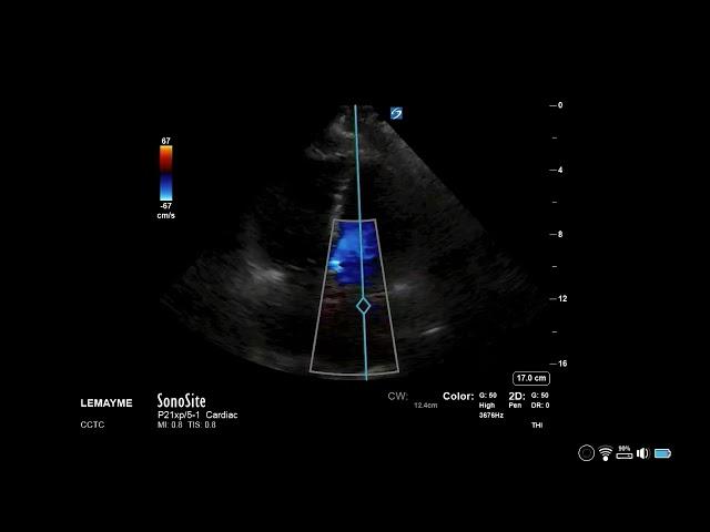 How to...Measure MVA using PHT or Deceleration Time