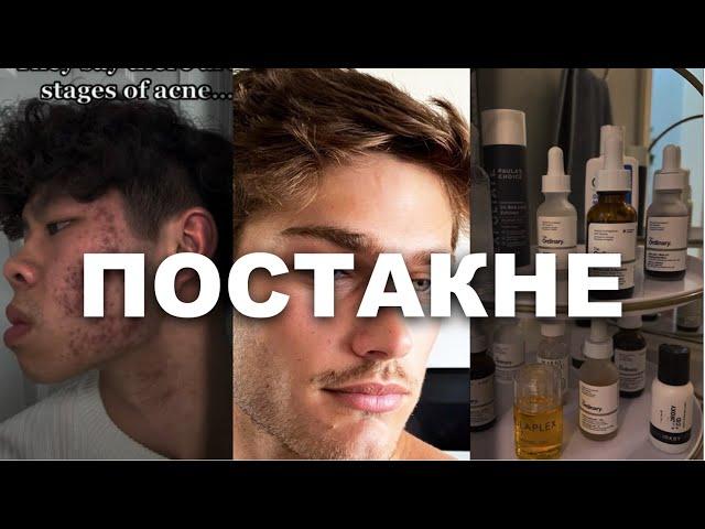 КАК УБРАТЬ ШРАМЫ ОТ ПРЫЩЕЙ // постакне