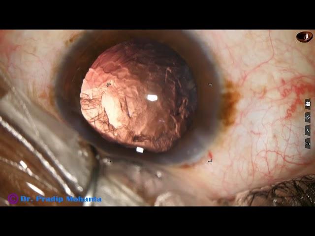 Management of a Posterior subcapsular cataract : Pradip Mohanta, 17th May, 2023